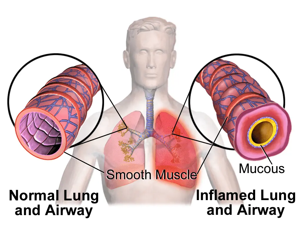 Bronchoconstriction Bronchoconstriction