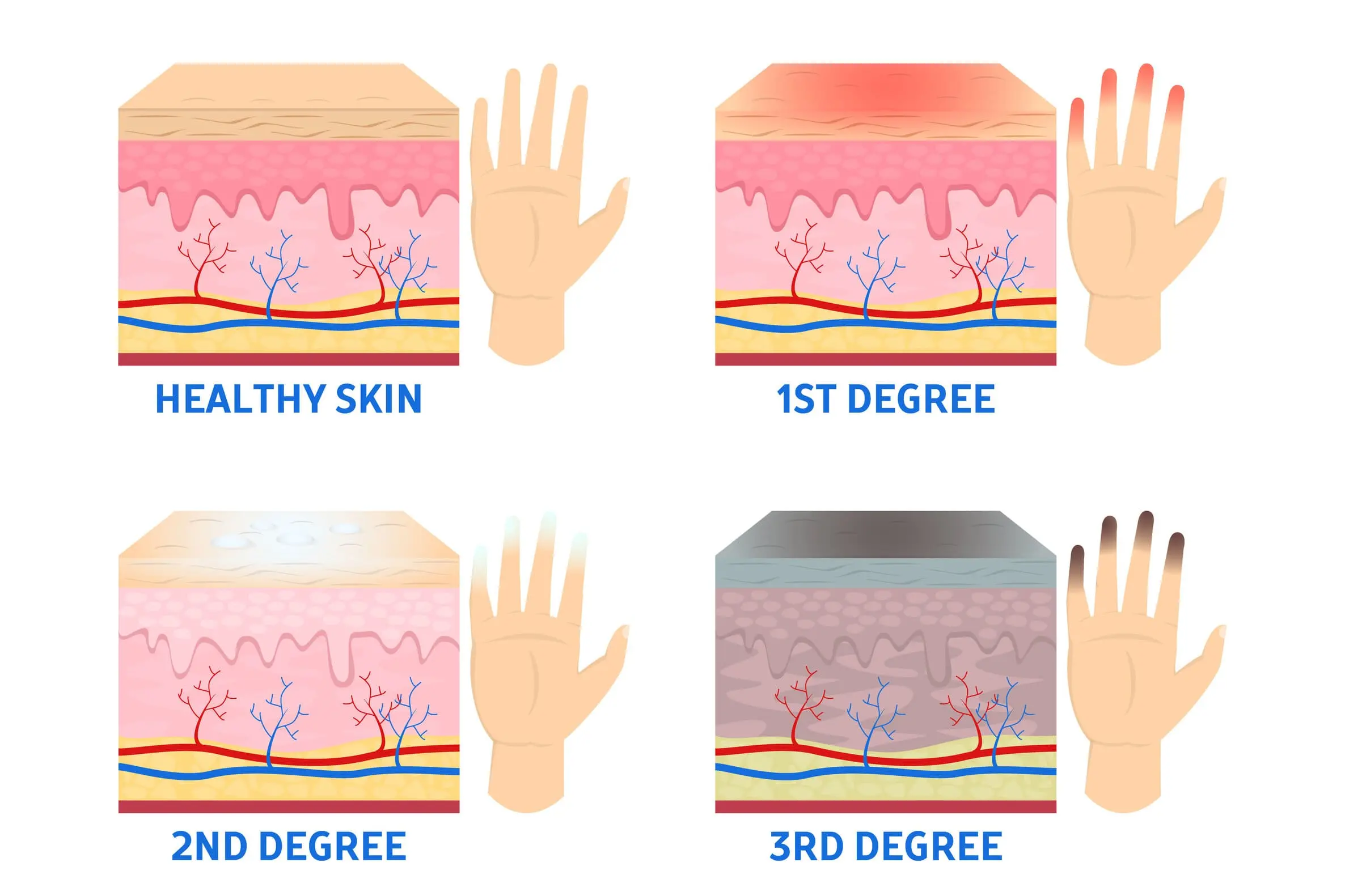 frostbite frostbite