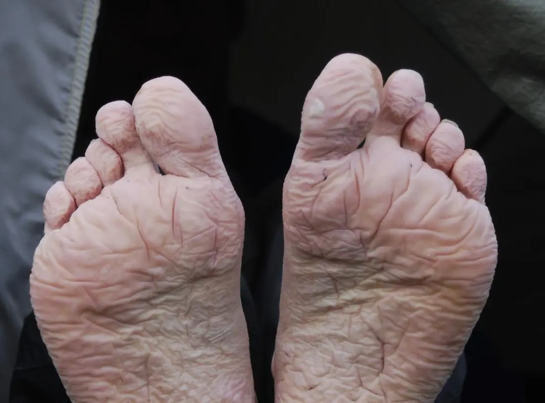 immersion foot immersion foot